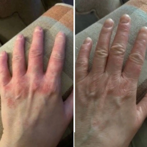 Click to view full screen Dermatitis & Gesunde Haut Creme – Lindert Juckreiz, Rötung und Schuppenbildung 50ml photo review