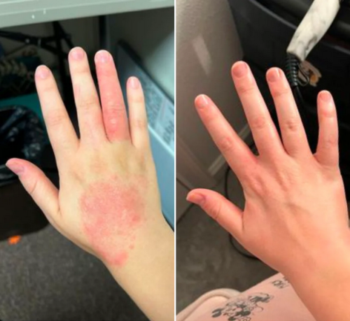 Click to view full screen Dermatitis & Gesunde Haut Creme – Lindert Juckreiz, Rötung und Schuppenbildung 50ml photo review