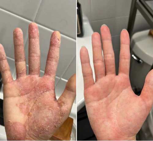 Dermatitis & Gesunde Haut Creme – Lindert Juckreiz, Rötung und Schuppenbildung 50ml photo review